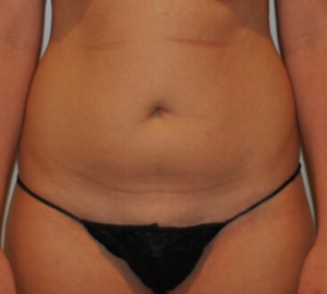 Before Image: Standard Liposuction