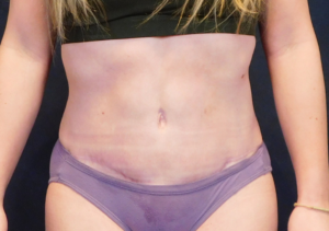 After Image: Tummy Tuck