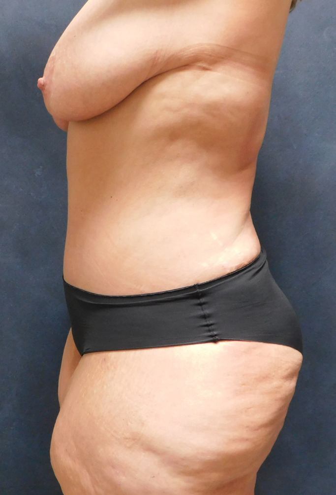 After Image: Tummy Tuck - left-side