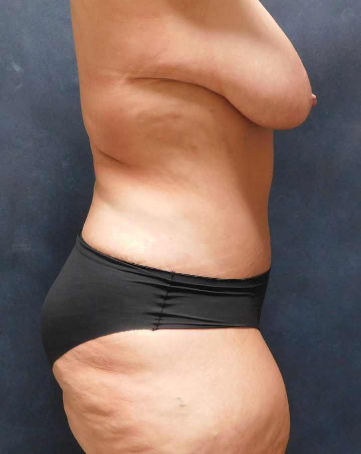 After Image: Tummy Tuck - right-side