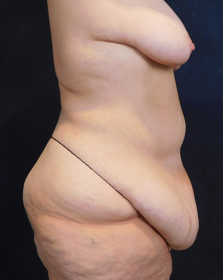 Before Image: Tummy Tuck - right-side