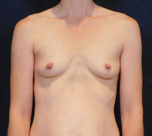 Before Image: Breast Augmentation