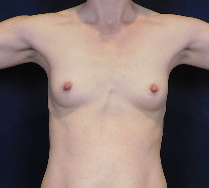 Before Image: Breast Augmentation - front