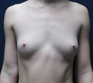 Before Image: Breast Augmentation