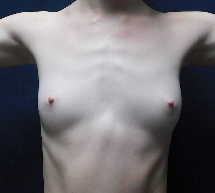 Before Image: Breast Augmentation - front