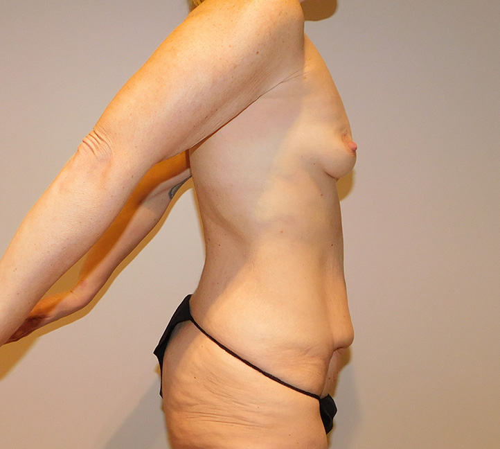 Before Image: Tummy Tuck and Breast Lift - right-side