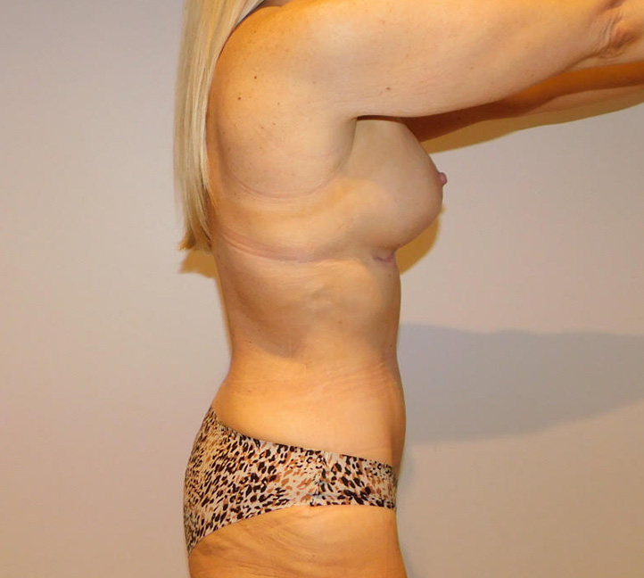 After Image: Tummy Tuck and Breast Lift - right-side