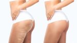 Cellulite treatment: From orange peel skin texture to smooth skin.