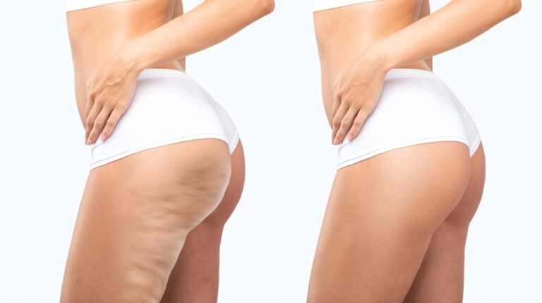 Cellulite treatment: From orange peel skin texture to smooth skin.