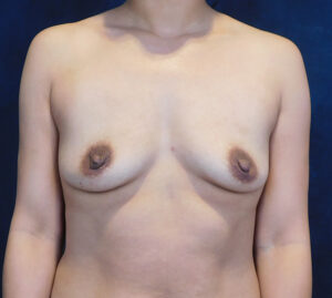 Before Image: Breast Augmentation