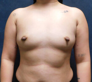 Before Image: Breast Augmentation