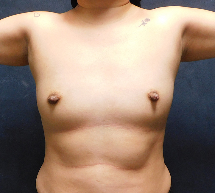 Before Image: Breast Augmentation - front