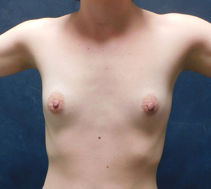 Before Image: Breast Augmentation - front