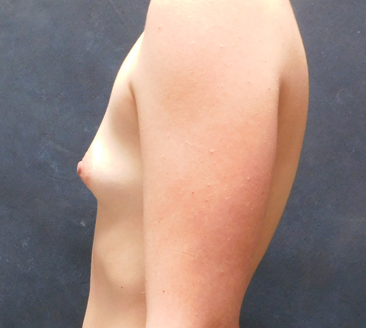 Before Image: Breast Augmentation - left-side