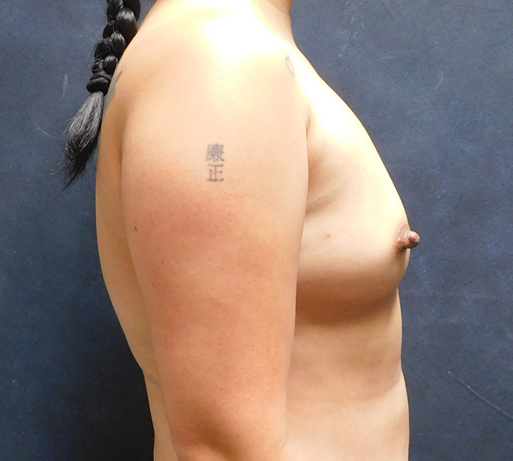 Before Image: Breast Augmentation - right-side