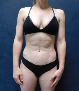 After Image: Hi def core Liposuction, Liposuction to thighs, calves, Renuvion, and Aveli