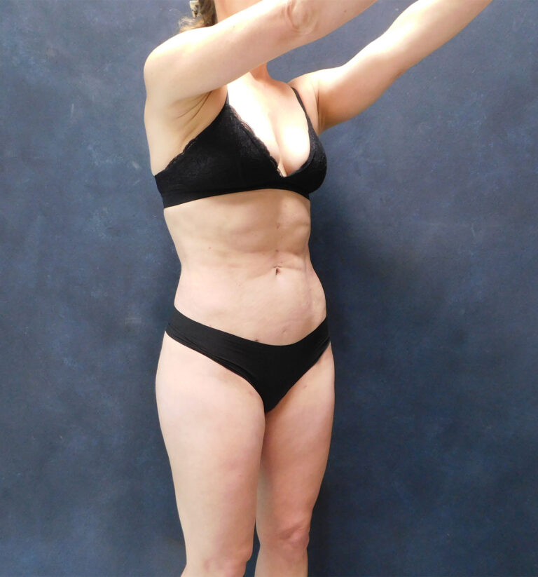 After Image: Hi def core Liposuction, Liposuction to thighs, calves, Renuvion, and Aveli - right-front-oblique