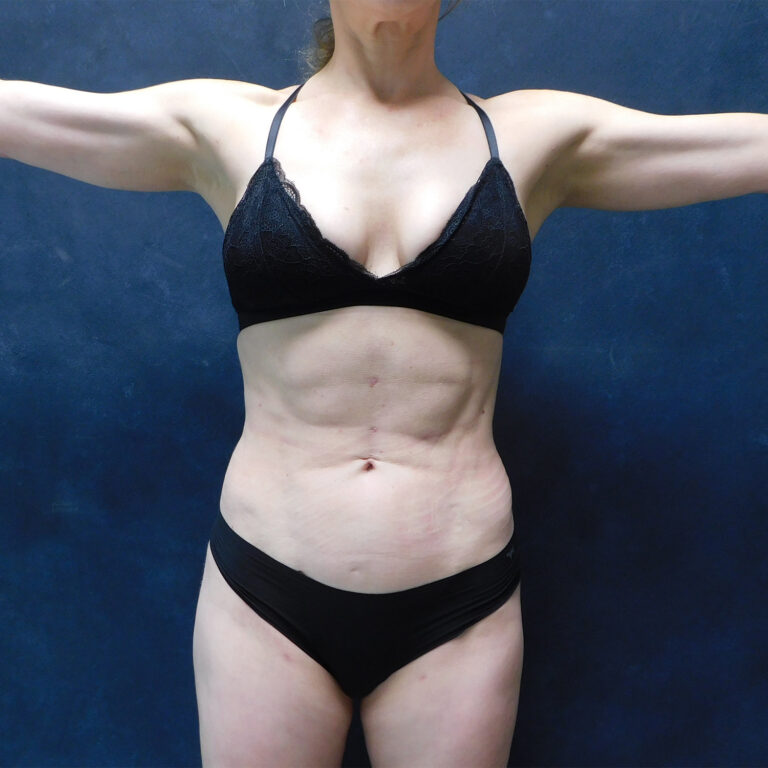 After Image: Hi def core Liposuction, Liposuction to thighs, calves, Renuvion, and Aveli - front