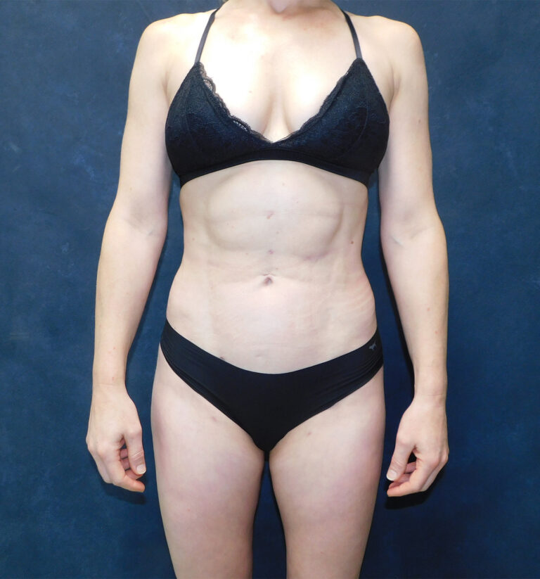 After Image: Hi def core Liposuction, Liposuction to thighs, calves, Renuvion, and Aveli - front