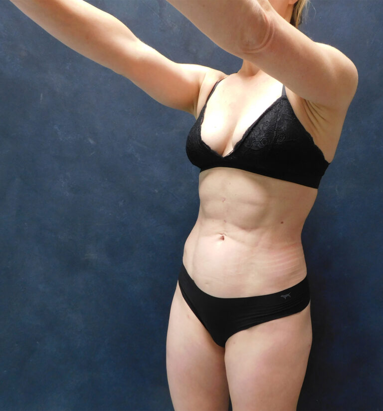 After Image: Hi def core Liposuction, Liposuction to thighs, calves, Renuvion, and Aveli - left-front-oblique