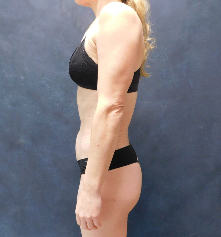 After Image: Hi def core Liposuction, Liposuction to thighs, calves, Renuvion, and Aveli - left-side