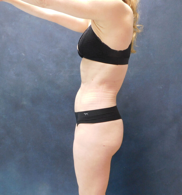 After Image: Hi def core Liposuction, Liposuction to thighs, calves, Renuvion, and Aveli - left-side