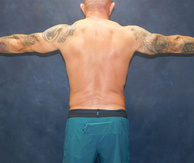 After Image: Liposuction, Renuvion - back