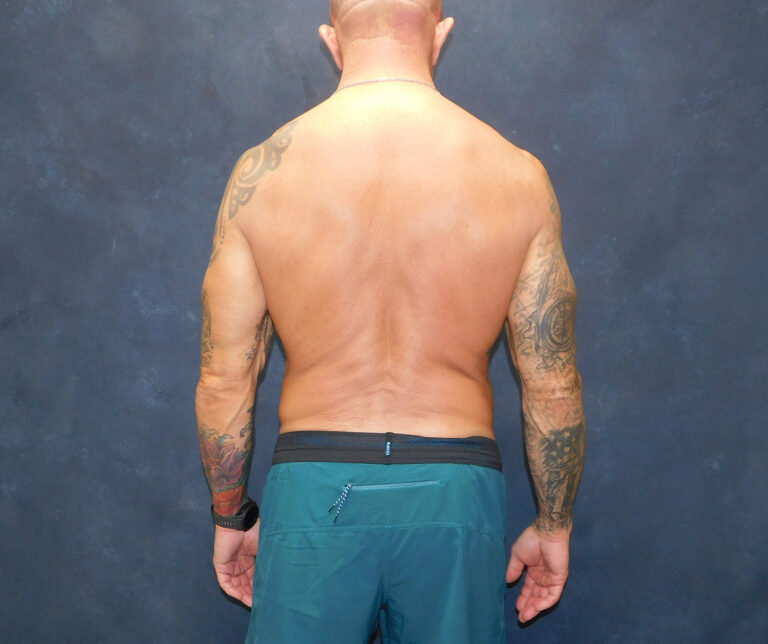 After Image: Liposuction, Renuvion - back