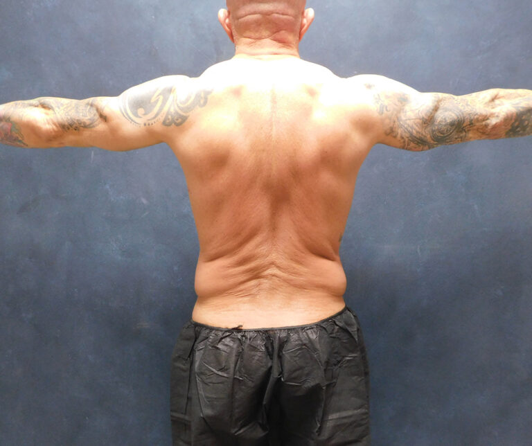 Before Image: Liposuction, Renuvion - back