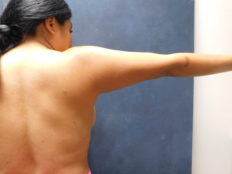 Before Image: Liposuction, Renuvion - back