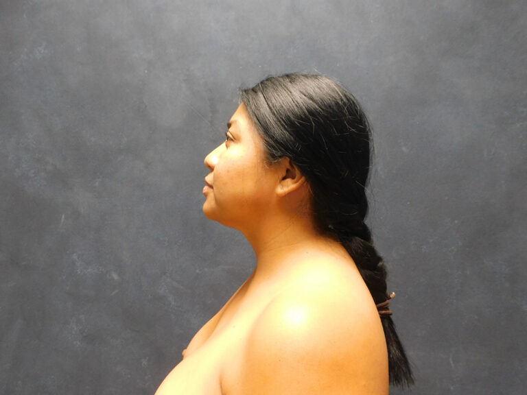 Before Image: Liposuction, Renuvion - left-side