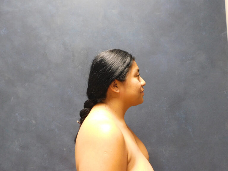 Before Image: Liposuction, Renuvion - right-side