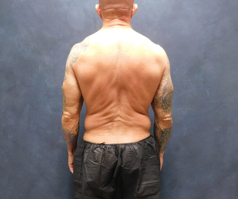 Before Image: Liposuction, Renuvion - back