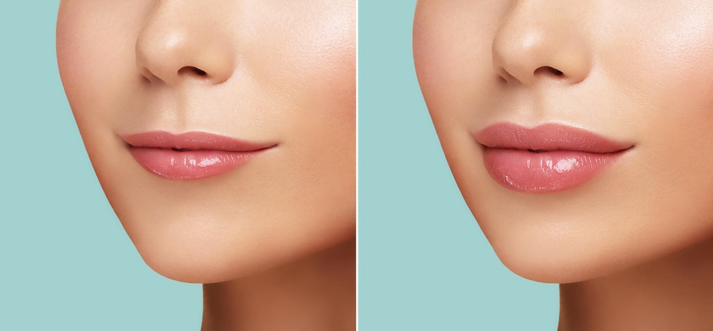 Comparison,Of,Women,Lips,Correction,Before,And,After,Hyaluronic,Acid